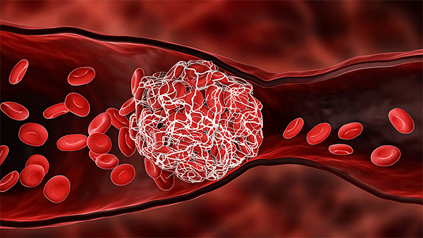 Cục máu đông là phản ứng tự nhiên khi mạch máu bị tổn thương 